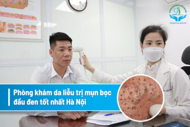 Hướng dẫn cách trị mụn trứng cá tuổi dậy thì