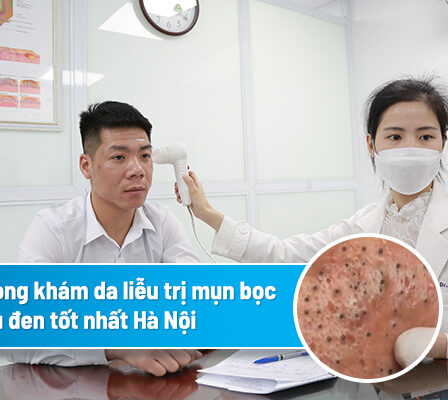 Hướng dẫn cách trị mụn trứng cá tuổi dậy thì