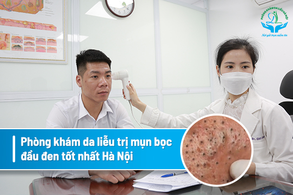 Hướng dẫn cách trị mụn trứng cá tuổi dậy thì